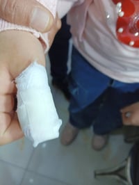 اليوم زارتنا الطفلة فاطمة من اهالي السيدية وعدها اظفرها ملتهب وتم قلعه...