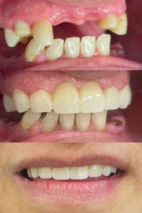 ابتسامة كاملة ١٠ أسنان • زاركون إيماكس • بلاك فرايدي