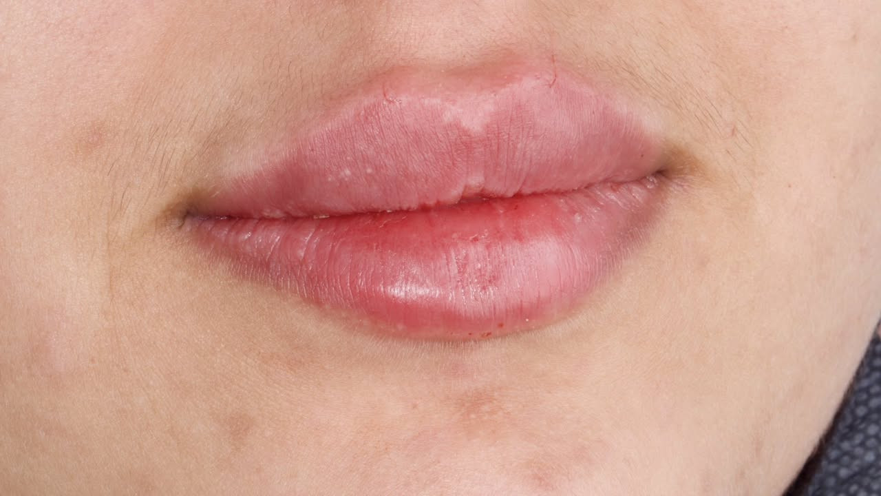 فلر  شفة بالتكنيك الروسي  1cc 💉👄

☎️للحجز والاستفسار مراجعة الصفحة او الاتصال بالرقم
***********

📍العنوان:عيادة الدكتور محمد حسن القريشي/واسط/الحي/شارع حي الوحدة قرب اسواق ريحانة

🛑علما ان المعاينة مجانية لتقويم الاسنان والتجميل اللاجراحي (فلر وبوتوكس)

#explore #واسط  #واسط #  #تجميلاسنان  #ترويج   #تقويمالأسنان
