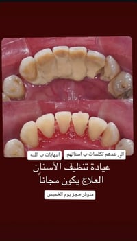 اللي عنده تكلسات تنظيف اسنان مجاني ٠٧٧٠٨٠٥٦٧١٩