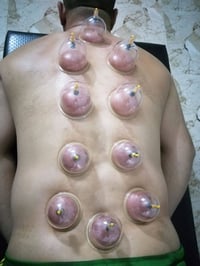 حجامة طبية • مركز الفهد • الرمادي التاميم