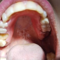 الي عنده اسنان تالفه او جدور مظهرها مو حلو وتسبب ريحة كريهة بالفم والي...