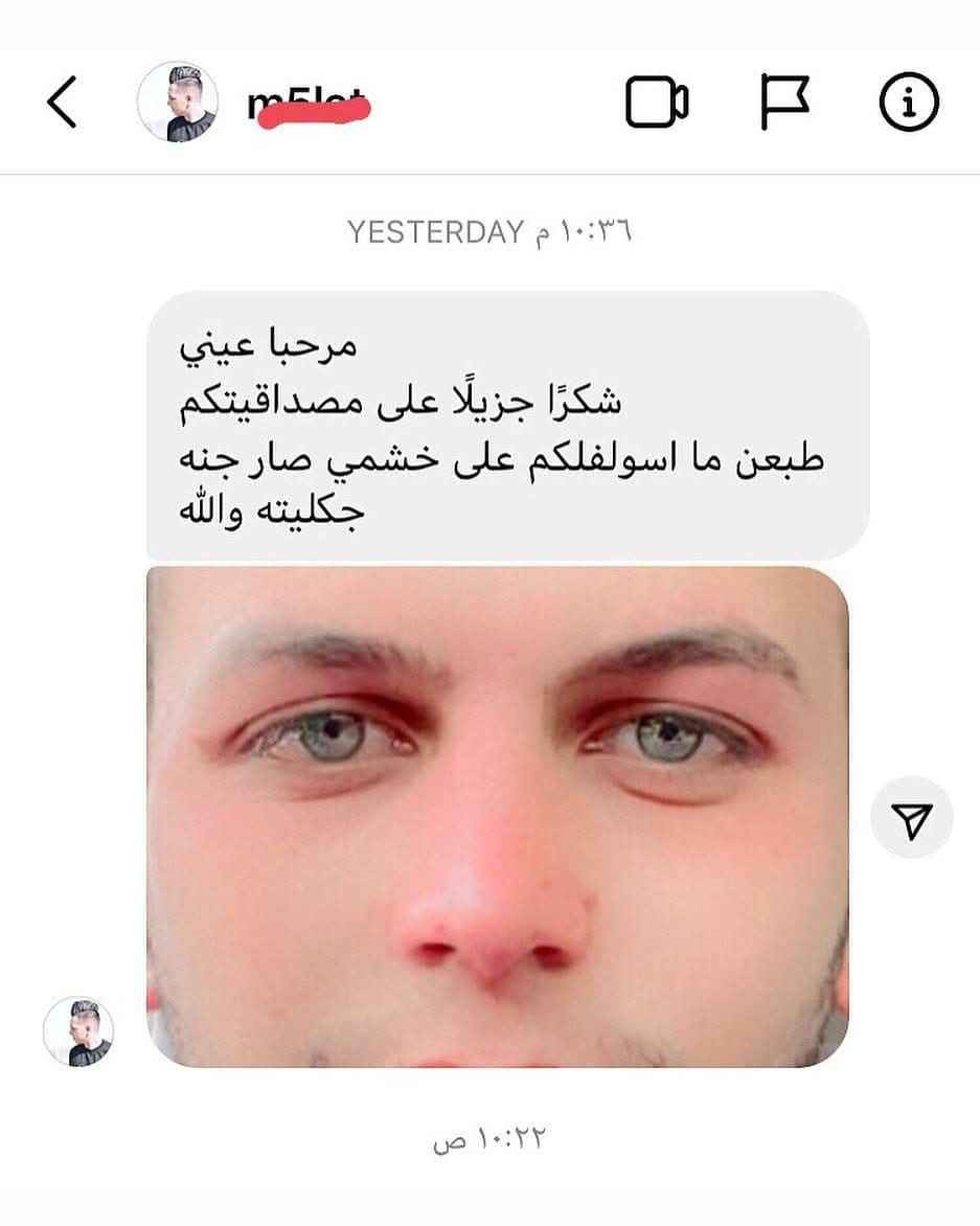 سيروم تصغير  الانف الاصلي 💯
للحصول على انف مثالي وبدون عمليات جراحية وتكاليف باهضه مع عرض تصغير الانف 

سيروم لتصغير الانف بدون عمليه بفتره قصيره وداخل المنزل
يتم استخدامه من خلال وضع قطرات من سيروم التنحيف العشبي ع منطقه الانف مع مساج بسيط وينصح بارتداء تقويم الانف للحصول ع نتائج مبهره وسريعه حجم السيرم 10ملم👃.

الصنع /كوري
السعر  خاص
يتوفر  توصيل لجميع محافظات العراق بغداد, العراق


**إذا كنت صاحب هذا الإعلان وتريد حذفه لأي سبب، رجاءا أرسل رسالة إلى الدعم الفني**