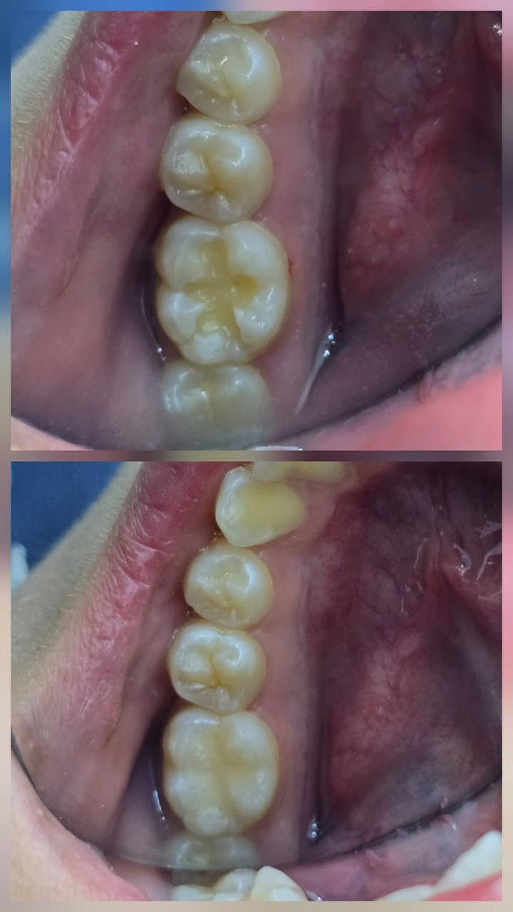 🦷حشوه ضوئية للأسنان الخلفيه 
عياده الاسكندريه لطب وتجميل الاسنان 
العنوان/ الاسكندريه ، خلف دائره الكهرباء ( مجمع الدكتور خالد عبد الخضر).
للحجز والاستفسار مراسله صفحه العياده او الاتصال على الرقم: 
***********
متواجدين يوميا من ٣ عصرا إلى ٩ باليل 

انستا العياده
 https://www.instagram.com/alexandria_clinic88?igsh=cjNtdWlmdWR1ODVu
الفيس 
https://www.facebook.com/share/1D2WrWPzQc/
