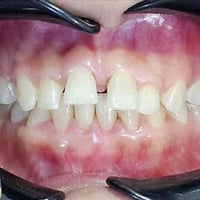 تقويم معدني • أسنان أمامية • المسيب شارع البلدية