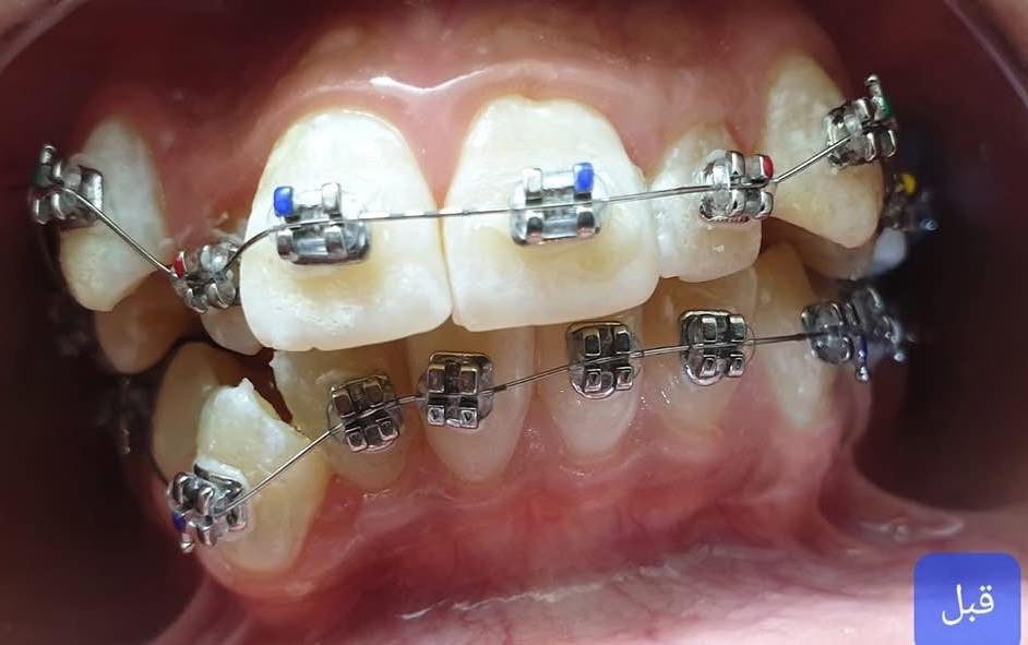 رفع التقويم بعد ترتيب وتعديل الاسنان للفكين
طبيب الاسنان الاختصاص د.عمار عباس
ماجستير تقويم وتجميل الاسنان M.S.c ortho
بكلوريوس طب وجراحة الفم والأسنان B.D.S
بغداد الشعب شارع عدن قرب  مركز شرطة الشعب  مدخل سوق شلال عمارة باريس الطابق الاول دوام العيادة جميع ايام الاسبوع ما عدا الجمعة عطلة من ٤ ل ٨  بدون حجز مسبق الدخول حسب اسبقية الحضور للعيادة الفحص والمعاينة مجاني للاستفسار ***********
