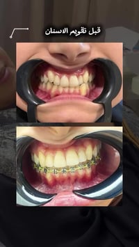 رأي المراجعه بعد تقويم الاسنان 😘🌸👍  ممكن متحتاج تغليف / فينير حته ترجع...