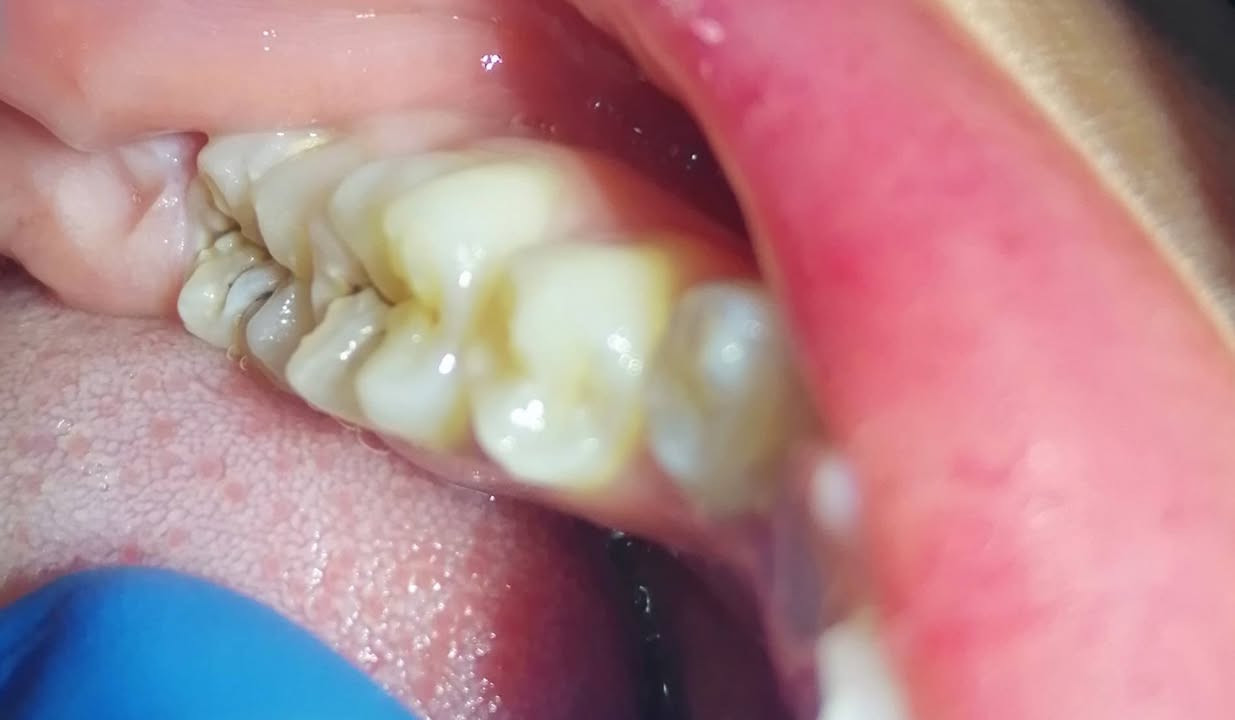 حشوه تجميليه للضرس السادس والسابع السفلي باستخدام العازل المطاطي.
د مهند عبد الجواد الطحان الهاشمي
ماجستير ودبلوم عالي تعويض الأسنان
سايدين مستشفى#القيارهالعام
مقابل باب الطوارى الرئيسي
مجاور صيدليه عبدالله المعماري
للحجز والاستفسار التواصل على الرقم ***********#
طابق ارضى
