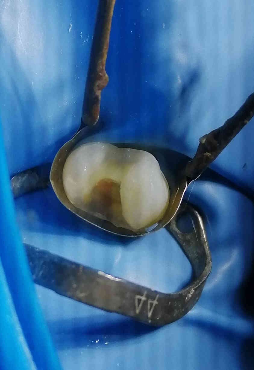 د مهند عبد الجواد... ماجستير تعويض الأسنان.. سايدين مستشفى القياره.. مقابل باب الطوارى الرئيسي.. مجاور صيدليه عبدالله المعماري.. طابق ارضى. ***********#
