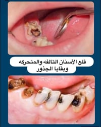 تتوفر لدينا عيادات مجانيه لقلع الاسنان المتحركه والجذور التالفه التسبب...