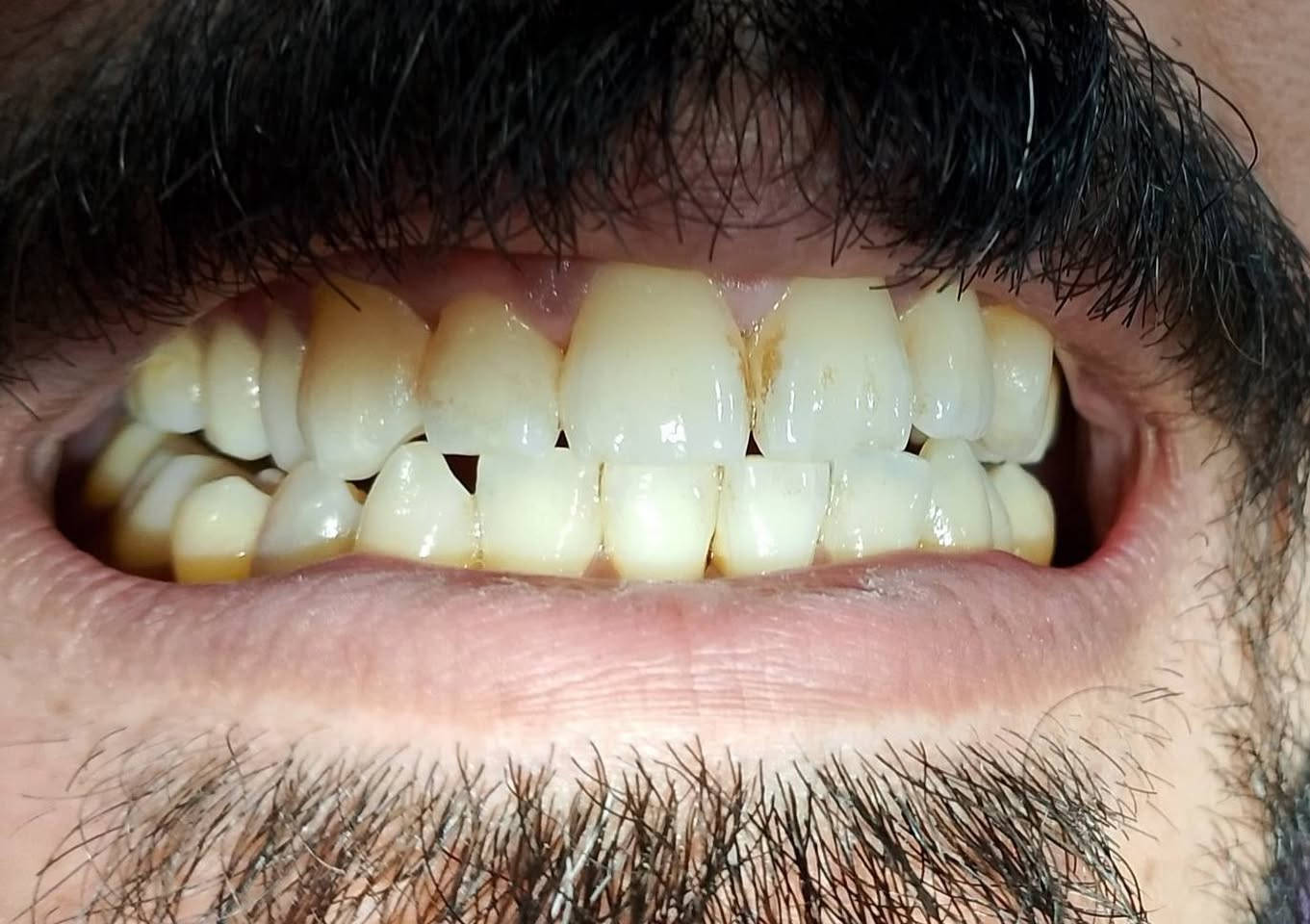 🦷 قبل وبعد تنظيف الأسنان وإزالة التكلسات 

إحدى الحالات التي تم العمل عليها داخل العيادات التعليمية

الفرق واضح في الوظيفة والمظهر 👌

🔹 الخدمات المتوفرة حاليًا (مجاني ):
• حشوات تجميلية ضوئية
• قلع الأسنان
• عمل طقم متحرك
• تنظيف الأسنان وإزالة التكلسات

📍 العمل يتم داخل العيادات وتحت إشراف مختصين

📱 للحجز والتواصل واتساب: (0770 984 7469)

#طبيب #اسنان # اكسبلور #فولو #لايك #تعليق
