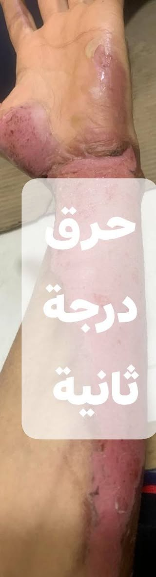#ضماد_حرق_درجة_ثانية
يوجد لدى عيادتنا كادر متخصص لعلاج و متابعة حالة الحرق من اول يوم إلى حد اكتساب الشفاء التام و يكون الضماد و المتابعة منزلية لا تحتاج إلى زيارة العيادة او مركز الحروق
نختصر عليك الوقت و الجهد و التكلفة

للتواصل
*********** واتساب
*********** اتصال

الله يحفظكم من كل سوء 🤍

 الصور👇 من متابعتنا لشخص محترق بالغاز أثناء عمله في المطعم
يسكن في مجمع الاميرات الثاني
