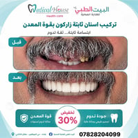 🔥 لفترة محدودة خصم 30% على تركيب الأسنان الثابتة (زاركون بقوة المعدن) ...