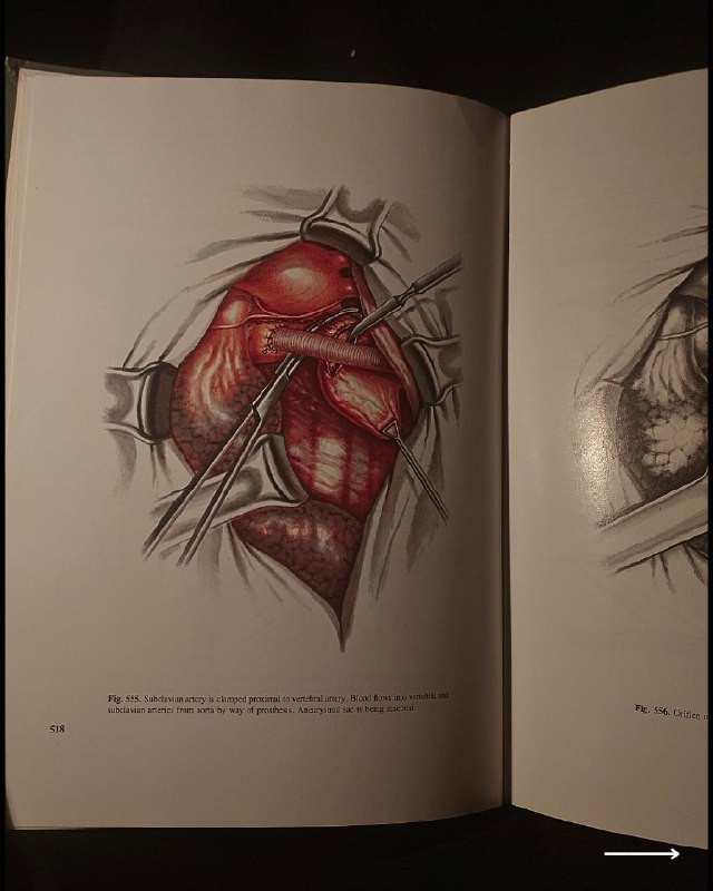 "أطلس جراحي طبي نادر وفخم من روائع الطب السوفيتي الأكاديمي! "
🚩
🫁
🩺
💚
📘
(Atlas of Thoracic Surgery - Volume Two)
المحرر: الأكاديمي بوريس ف. بيتروفسكي (Academician Boris V. Petrovsky).
⚜️
📚
🚩
☭
✨
عن هذه النسخة التراثية:
سنة الطبع: 1979م (طبعة أصلية قديمة ونادرة صادرة عن دور النشر العلمية السوفيتية المترجمة للإنجليزية).
الحالة: ممتازة
✅
⚜️
الموضوع:
أطلس جراحي موسوعي وفخم يتناول جراحة الصدر والأوعية الدموية الكبرى والقلب والرئتين بالتفصيل التشريحي والعملياتي الدقيق، يضم مساهمات كبار علماء الجراحة في الاتحاد السوفيتي السابق، يهم جداً أطباء جراحة الصدر والقلب، طلاب كليات الطب والصيدلة، وهواة اقتناء المراجع الطبية التراثية الأجنبية النادرة.
🔹
السعر: 35 د. ع.
📜
للحجز
🔻
:
البوت:
@PH_900bot
أو واتساب: ***********
