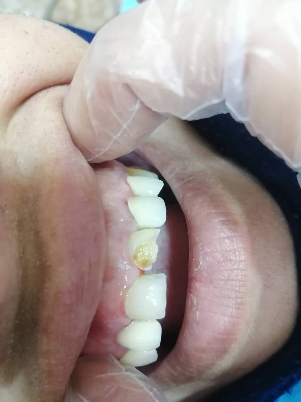 ترميم السن الأمامي المكسور ..
د مهند عبد الجواد الطحان الهاشمي
ماجستير ودبلوم عالي تعويض الأسنان.. سايدين مستشفى #القيارهالعام.. للحجز والاستفسار التواصل على الرقم ***********# مجاور صيدليه عبدالله المعماري.. طابق ارضى.
