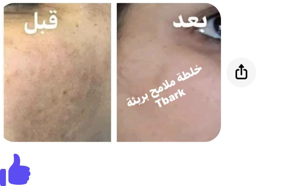 تم تجهيز خلطات لتبيض وتفتيح البشرة مع معالجة الكلف والتصبغات  ✨

بدون اي اضرار للبشرة خلي بشرتك اجمل مع خلطة ملامح بريئة
او راسلونا عالخاص


**إذا كنت صاحب هذا الإعلان وتريد حذفه لأي سبب، رجاءا أرسل رسالة إلى الدعم الفني**