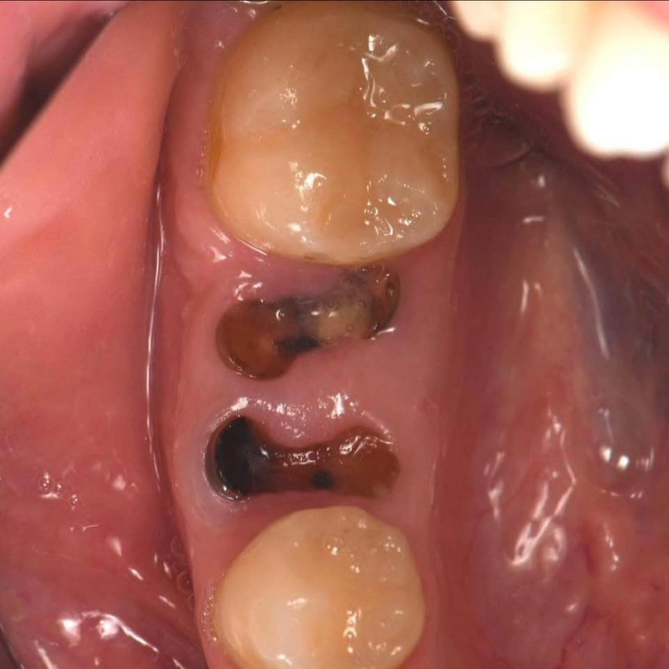 السلام عليكم طالبة طب اسنان مرحلة رابعة الاسبوع القادم نبلش شغل بعيادات اللي محتاج :
١_قلع الاسنان التالفة وبقايا الجذور 
٢_تنظيف الأسنان وازالة التكلسات والتصبغات
العلاج مجاني فقط حساب الوصل 
يتم العلاج تحت إشراف اطباء أختصاص ✅

العنوان/ الرمادي / جامعة المعارف 

للتواصل واتساب ***********
