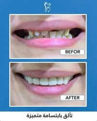 الزعفرانية بغداد • تقويم اسنان • تبييض اسنان