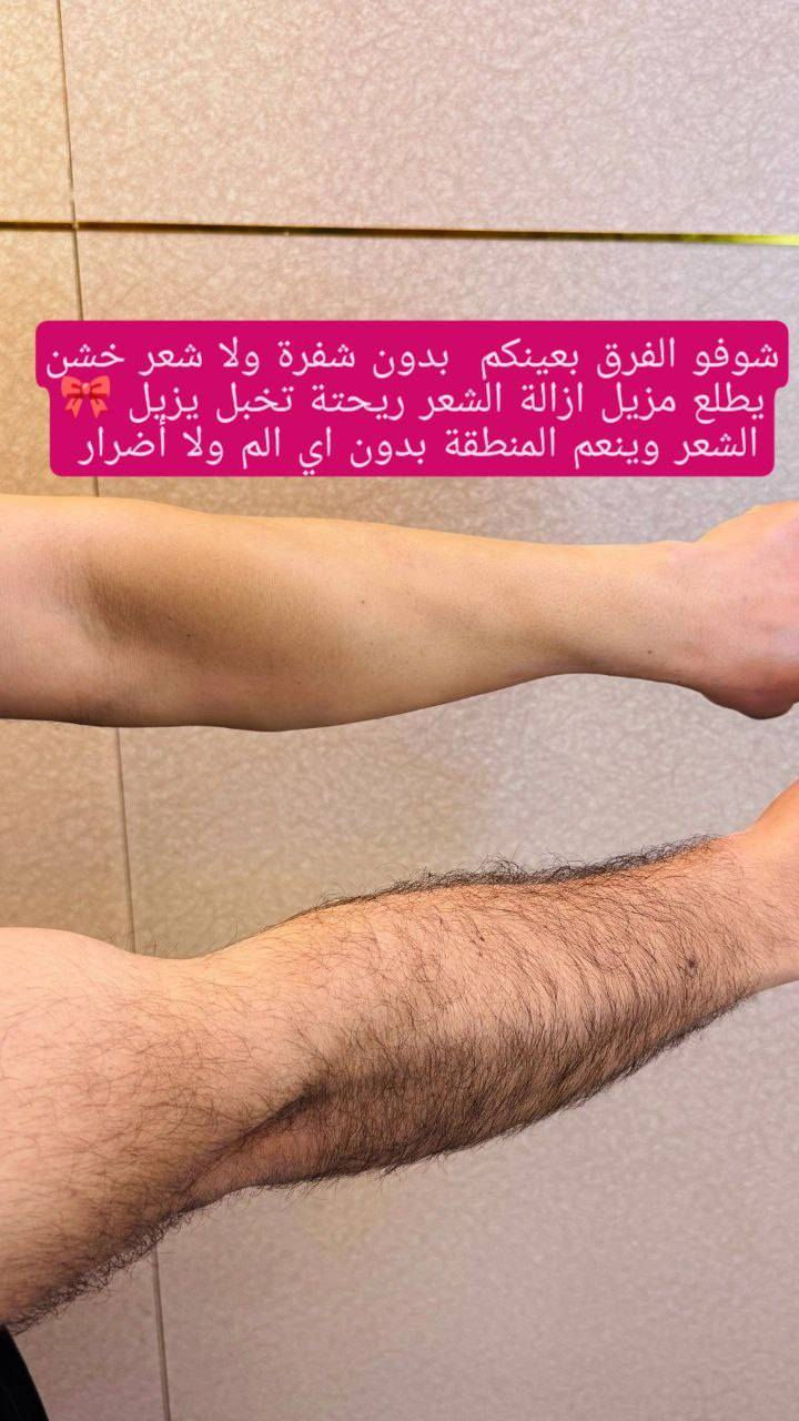 وصل الجديد كريم ++سيروم مانع النمو بديل ليزر 

🙂‍↔️🫶🏻  عشق الشباب والبنات 

كريم إزالة الشعر من ماركة ENZO، وهو مخصص للبشرة الحساسة وللاستخدام على الجسم والساقين. 

🩷 مصمم خصيصاً ليناسب البشرة الحساسة، مما يقلل من احتمالية حدوث تهيج أو احمرار.

🩷 يحتوي على زبدة الشيا والصبار (Aloe Vera) لترطيب البشرة وتهدئتها أثناء وبعد عملية الإزالة.

🩷 يعمل الكريم خلال وقت قصير (يظهر على العبوة رمز 3 دقائق) لإزالة الشعر بفعالية.

🩷  يمنح البشرة ملمساً ناعماً ومنعشاً 

طريقة الاستخدام 🎀
توزيع طبقة متساوية وكثيفة من الكريم على المنطقة المطلوبة دون فركه.
تركه للمدة المحددة (عادةً من 3 إلى 10 دقائق كحد أقصى حسب كثافة الشعر).
إزالة الكريم باستخدام الأداة المرفقة أو قطعة قماش مبللة، ثم شطف المنطقة جيداً بالماء الفاتر

كريم مع سيروم

توصيل لجميع المحافظات العراق


**إذا كنت صاحب هذا الإعلان وتريد حذفه لأي سبب، رجاءا أرسل رسالة إلى الدعم الفني**