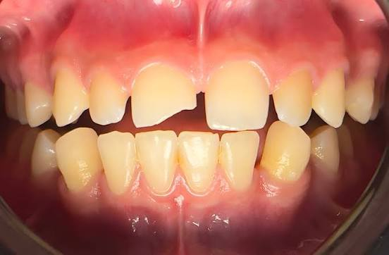 سلام عليكُم
اذا عدكم هيج كسر بأسنانكم وتريدون تسوونة 
مجاني وشغل حلو بأمانتي 
راسلوني  ***********
