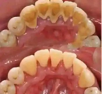 📌 إعلان من عيادات طب الأسنان 📢

يسر عيادات طب الأسنان في كربلاء المقدسة أن تعلن عن استقبال المراجعين مجانا بإشراف كادر تدريسي ومتخصص من أطباء الأسنان.

🦷🩺والخدمات المجانية تشمل:

✨فحص وتشخيص الأسنان واللثة

✨الحشوات التجميلية الضوئية

✨تنظيف الأسنان وإزالة الجير والترسبات

✨قلع الأسنان والجذور والأسنان التالفة

✨عمل التركيبات السنية الأطقم والجسور

📌 الموقع كربلاء المقدسة - شارع الحر - عيادات جامعة اهل البيت

🕣 أوقات المراجعة من الساعة 8:30 صباحاً حتى 1:00 ظهراً خلال أيام الدوام الرسمي

📞📱للتنسيق والحجز • عبر الاتصال أو الواتساب على الرقم ***********

https://wa.me/9647830340502?text=سلام%20عليكم%20دكتور...%20اريد%20احجز
