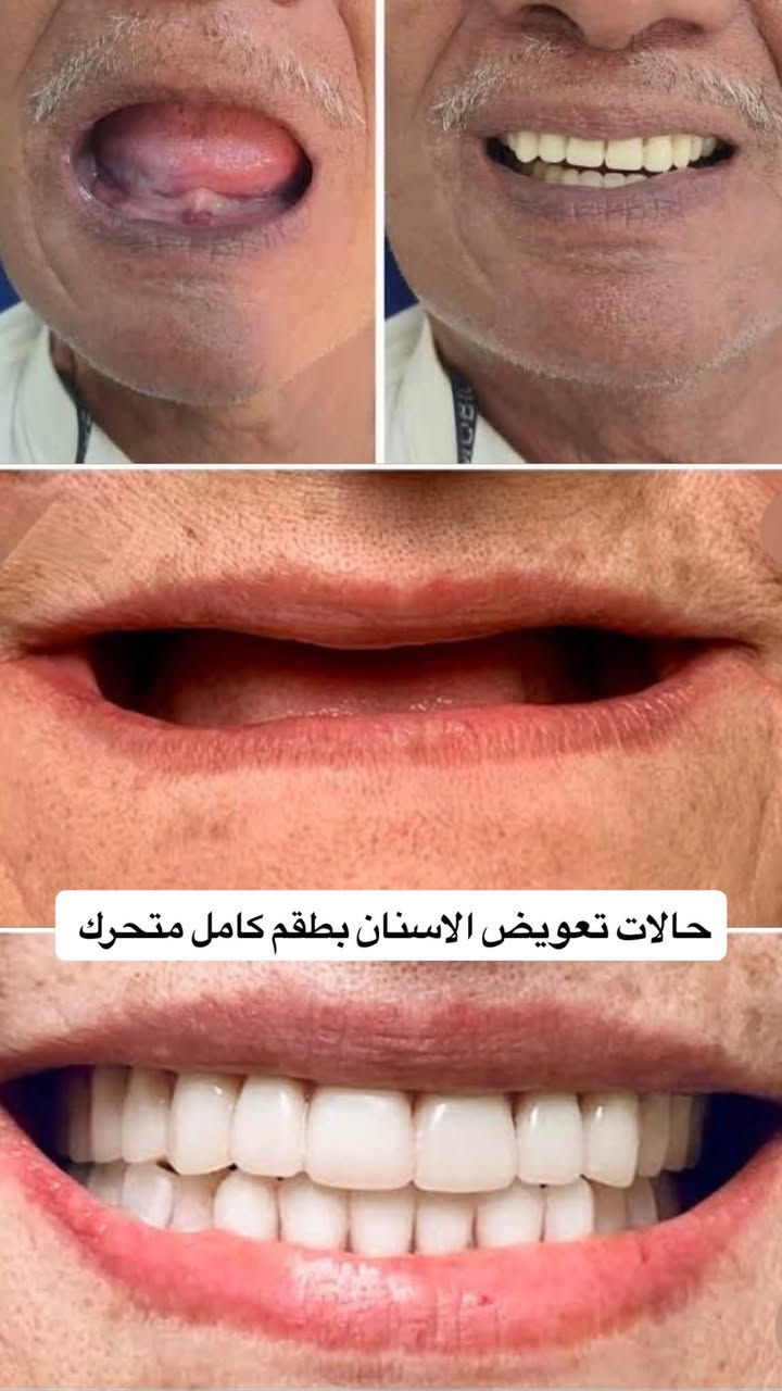السلام عليكم💗💗
استقبال المرضى في عيادات كلية طب الأسنان في جامعة اهل البيت (ع).

المعالجة مجانية وبإشراف أخصائيين 

المعالجات المتوفرة:
🔶قلع أسنان
🔶التعويضات بأطقم متحركة
🔶 حشوات ضوئية 
🔶تنظيف الاسنان وازالة التكلسات 

الرجاء التواصل على الحسابات التالية:

الإنستغرام: 10_marb 
الواتساب:***********
