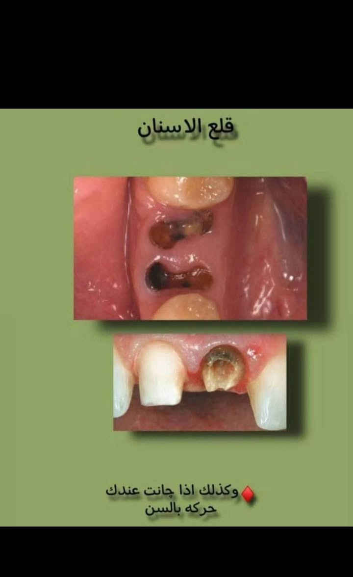 قلع مجاني ✨️✨️
قلع مجاني ✨️✨️
العنوان جامعة المنارة قرب مستشفى الصدر 
للإستفسار دايركت 
نستقبل اغلب الحالات 
بقايا الجذور والأسنان المتحركة


**إذا كنت صاحب هذا الإعلان وتريد حذفه لأي سبب، رجاءا أرسل رسالة إلى الدعم الفني**