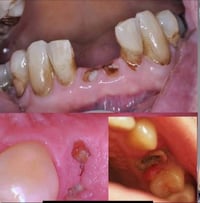 اللي محتاج قلع جذور متبقية العلاج مجانًا بالكامل  مع دفع اجور النقل ال...