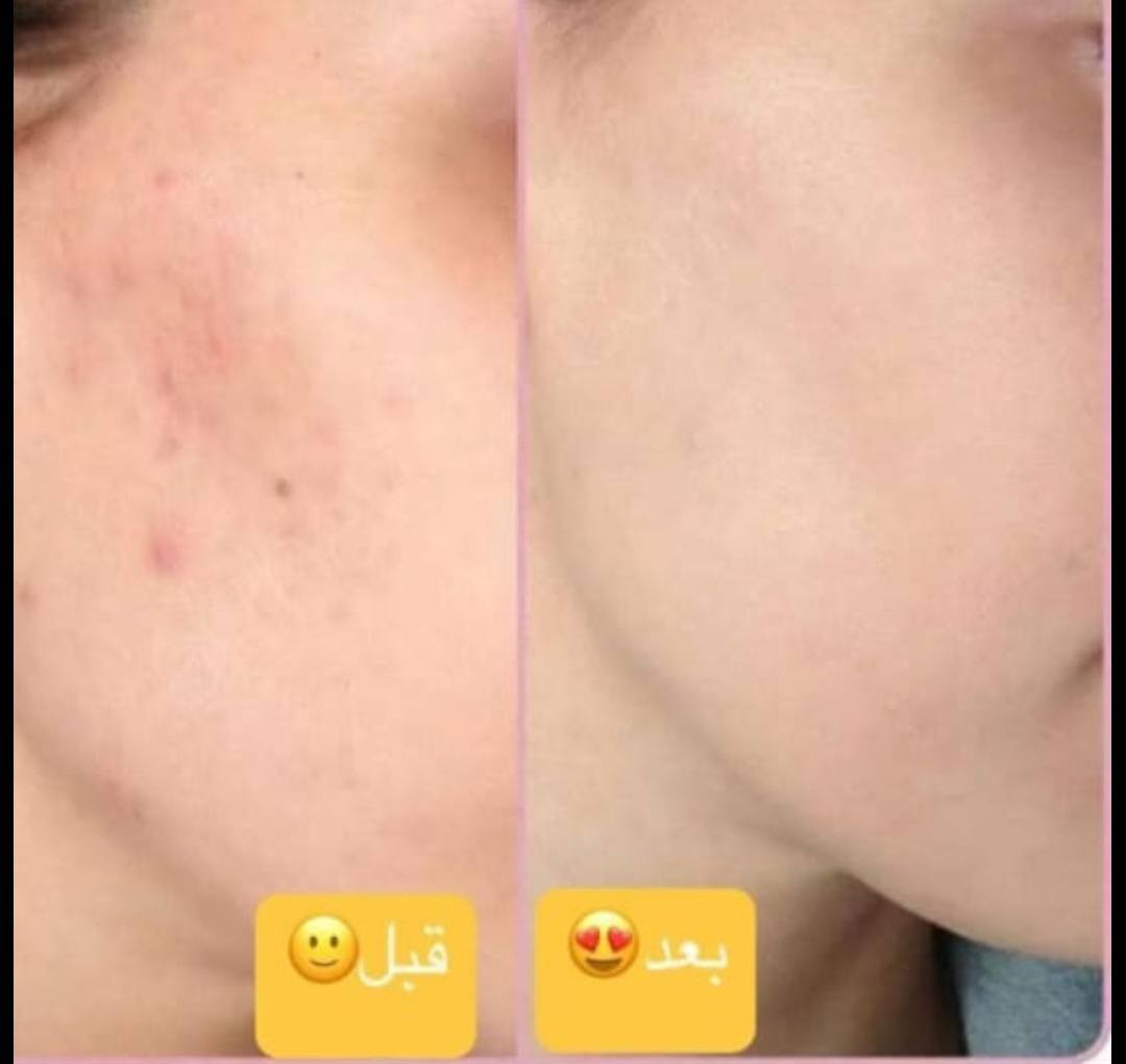 🌸خلطة تبيض الوجه 🌸

🌸خلطة للنمش والكلف والتصبغات🌸

مضموونه ومجربه100%💯
طبعا الخلطه مجربه ومضمونه 🌹

🌹لتبيض الوجه خلطة بالفتامين والاعشاب .. اعطاء نظارة واشراقه بياض دائمي وليس وقتي🌹

🌹لازالة التصبغات والكلف الناتجه عن الحراره او عن اشياء اخرى🌹تنعيم وتبيض ما في اي خشونه 😍انوثه 
المنتج للوجه /فرق خلال أول اسبوع

مضمونه وصحيه وامنه ولاتسبب اي اعراض جانبيه 

(( خلطه من مواد  طبيعيه اعشاب وفيتامينات موجود فيها اقويه
(( مناسبه للبشره الحساسه )


**إذا كنت صاحب هذا الإعلان وتريد حذفه لأي سبب، رجاءا أرسل رسالة إلى الدعم الفني**