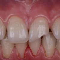 حشوات تجميلية • قلع أسنان • مجاني