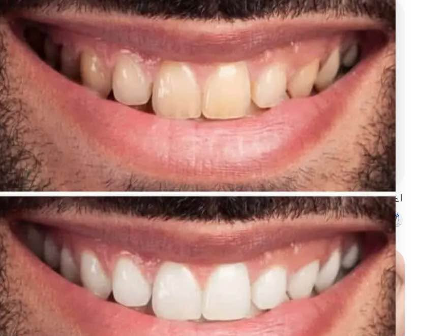قلم تبييض الأسنان بتركيبة مميزة يساعد على تقليل مظهر التصبغات الناتجة عن القهوة، الشاي، التدخين والأطعمة، ويمنح الأسنان مظهرًا أكثر بياضًا ولمعانًا

⚙️ طريقة الاستخدام

1️⃣ تنظيف الأسنان وتجفيفها جيدًا
2️⃣ لف القلم حتى يخرج الجل
3️⃣ وضع طبقة رقيقة على الأسنان الأمامية
4️⃣ تركه لمدة 30 دقيقة بدون أكل أو شرب
5️⃣ تكرار الاستخدام حسب الحاجة للحصول على أفضل نتيجة

التوصيل متوفر بغداد, العراق


**إذا كنت صاحب هذا الإعلان وتريد حذفه لأي سبب، رجاءا أرسل رسالة إلى الدعم الفني**