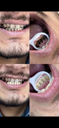 تنظيف الأسنان في عيادة المروج  مو بس تجميل… هو حماية لابتسامتك! بسعر (...