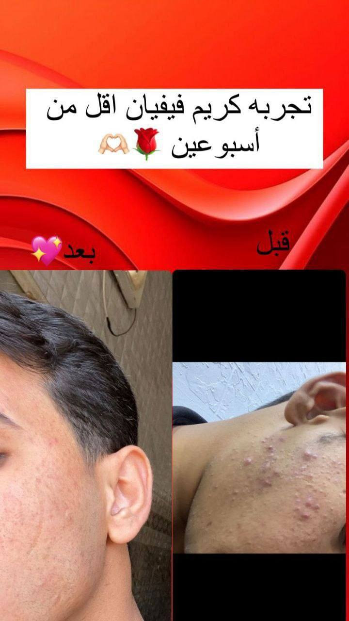 فيفيان كريم الشكل الجديد  الاصلي 
احد اهم افضل المنتجات لتبييض البشرة 
من خلال مكوناته الطبيعية يمنحك نتائج من اول أسبوع استخدام .
بشرة صحية واكثر نضارة و بخطوات بسيطة .
يبيض البشرة - يعالج الكلف - يعالج التصبغات - يعالج الهالات التحت العين - يرطب البشرة وتصبح اكثر نضارة 
.
كريم فيفيان منتج. متوفر للبشره الحساسه والعادية
السعر 30
توصيل لجميع المحافظات


**إذا كنت صاحب هذا الإعلان وتريد حذفه لأي سبب، رجاءا أرسل رسالة إلى الدعم الفني**