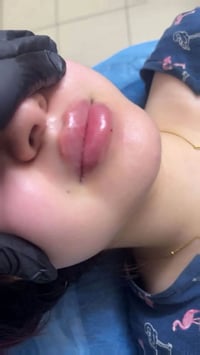 فيلر شفايف • طبيعي • ميرو للتجميل