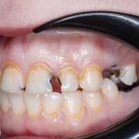 حشوتين جلسة وحدة • ترميم شكل الأسنان • المسيب شارع البلدية