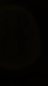 مستشفى الزهراء • رفع نزف دماغي • كسر منخسف