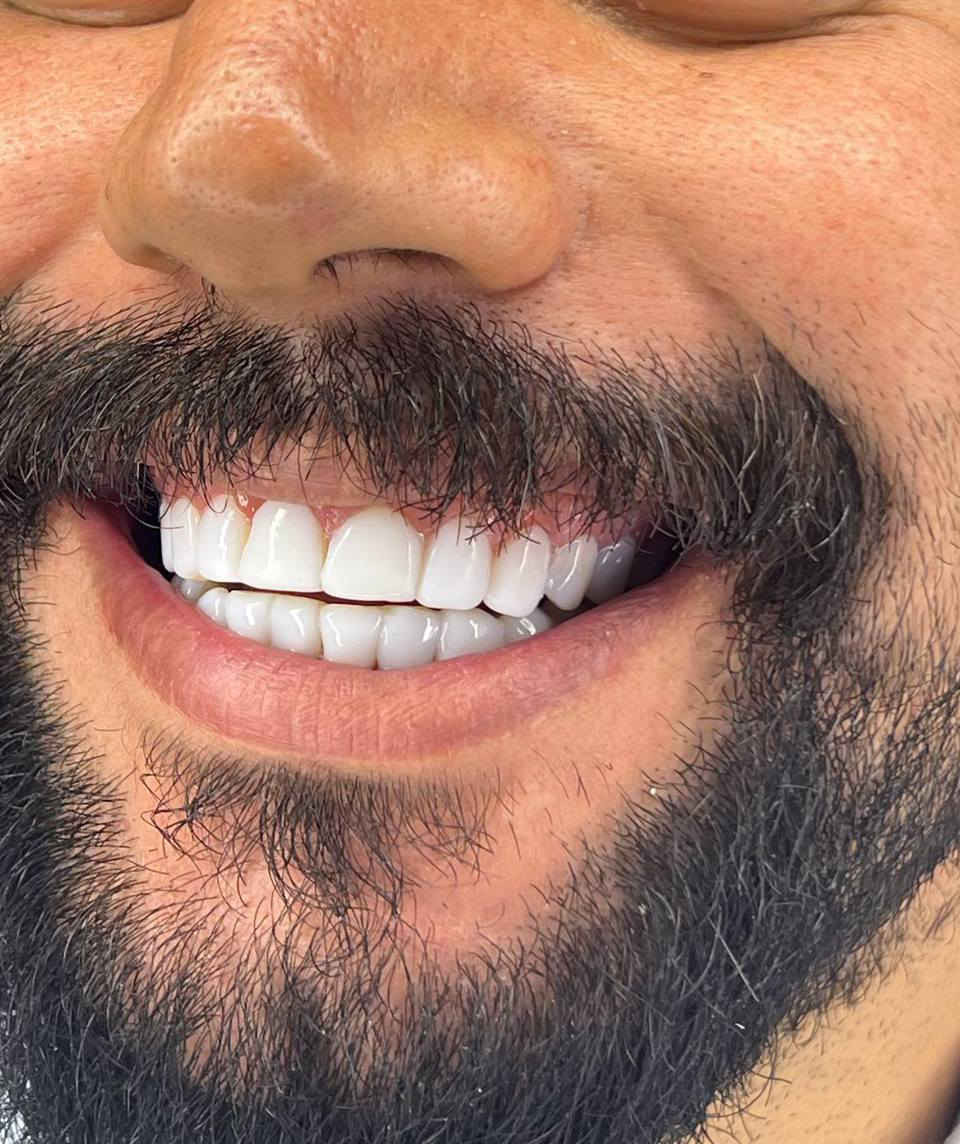 ابتسامة ما تنسى لكل الأعمار! ✨
بسعر مغري جدا لفترة محدوده

جلسة سريعة، نتيجة فورية… الكل يستحق يبتسم بثقة 💎

عيادة دكتورة الدكتورة هند الحسيني 
***********
