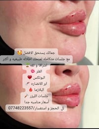 جمالك يستحق الافضل 🥰 مع جلسات متكامله تمنحك اطلاله طبيعيه و أكثر اشراق...