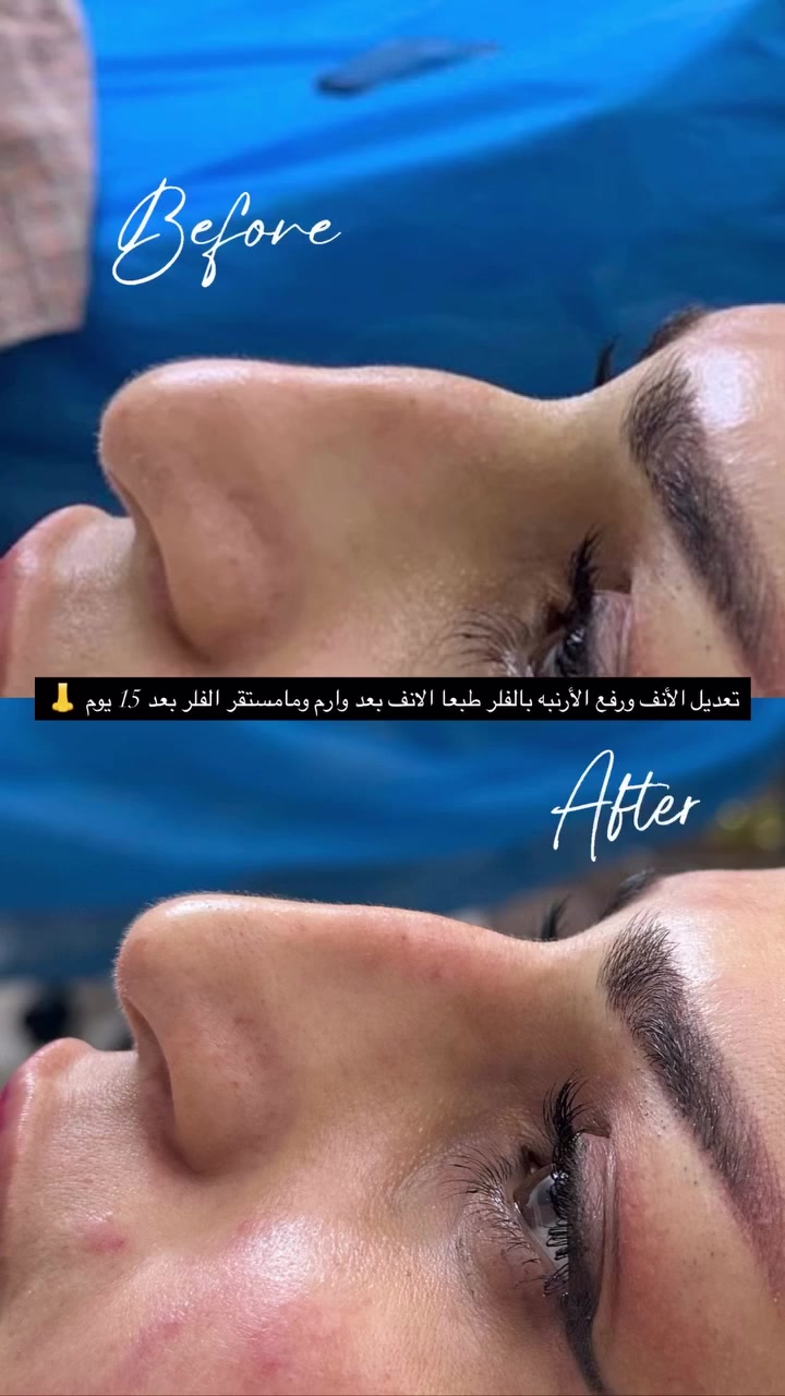 #عيادة فلورا للتجميل والليزر والاسنان 

#جلسه تعديل الأنف ورفع الارنبه بالفلر الأنف بعد وماستقر الفلر بعد ١٥يوم 

 #العنوان؛ طوز _ سوك الجمهوريه  _ مجاور ملبوسات مختار 
طابق تأني لجامعة 
الرقم؛ ***********📞

#علما_ليس_لدينا_فرع_اخر 🧿
