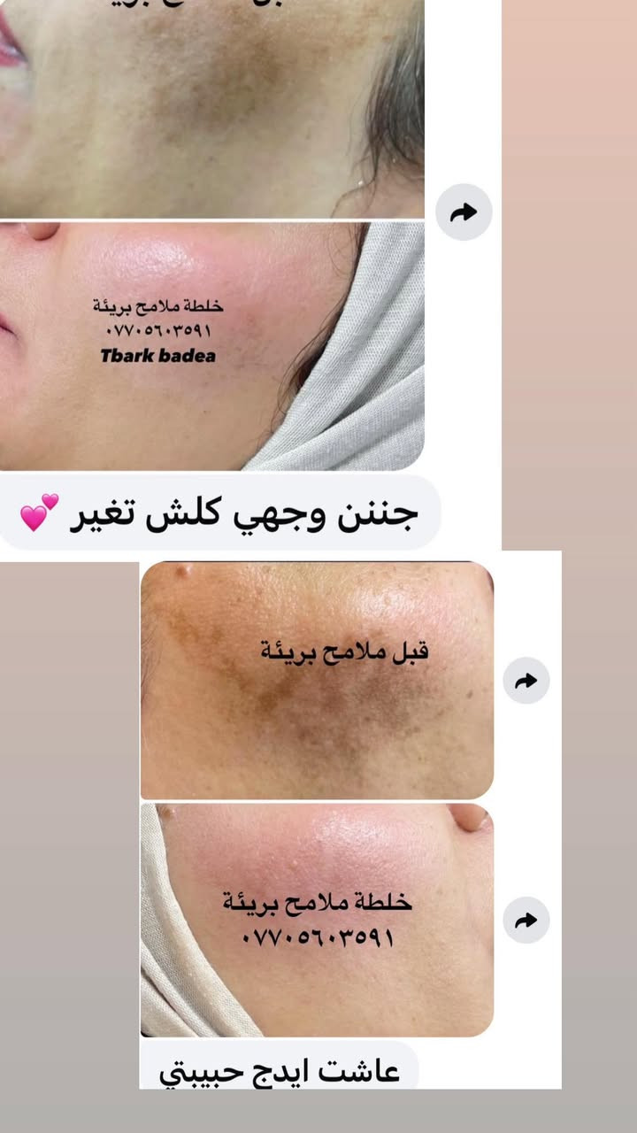 عليها القرأن الي مجربه براندي خلطة ملامح بريئة وفايدها تعلق اهنا بنات يتابعون التعليقات يردون يستخدموهاويستفسرون منكم  👈🌹


**إذا كنت صاحب هذا الإعلان وتريد حذفه لأي سبب، رجاءا أرسل رسالة إلى الدعم الفني**