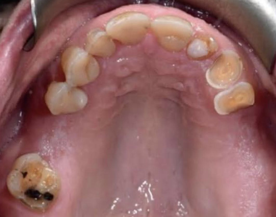 علاج مجاناً مجاناً
اللي عنده فقدان بالأسنان خلفية نعوضهم باسنان صناعية يحجز موعد على واتساب ***********
