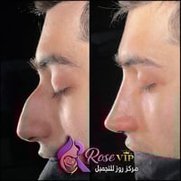 تجميل الأنف • روز VIP • الحارثية بغداد