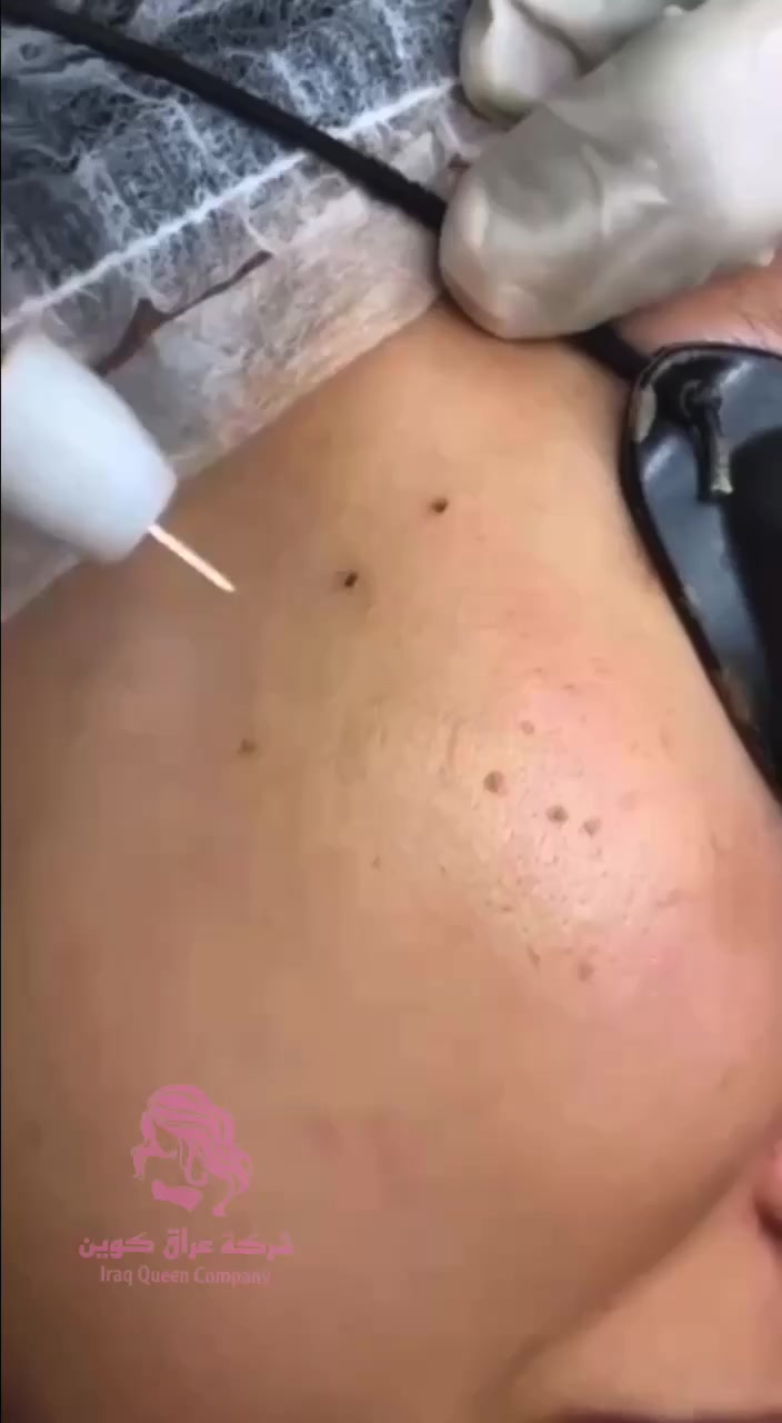 من شركة انزو الاصلية 💯💯
جهاز ازالة الشام والزوائد اللحمية والفالول فعال ومضمون 🌺
جهاز ازالة الشامات والحبوب والزوائد  ( الفالول) 💯 ✔️ 
تستطيعين من خلاله ازالة الشامات غير المرغوبة ✔️
ازالة الزوائد نهائيا ✔️
ازالة الفالول وعدم عودته ✔️ ✔

جهاز عملي جدا وسهل الاستعمال يعمل عالشحن ويجب شحنه قبل استعماله 👍

السعر 🔥🔥و التوصيل مجاني 
🚘 يوجد خدمة توصيل لجميع محافظات العراق 🚘


**إذا كنت صاحب هذا الإعلان وتريد حذفه لأي سبب، رجاءا أرسل رسالة إلى الدعم الفني**