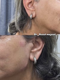 نتيجة حقن الفلر ❤️💉💉 العنوان :الغزالية شارع المشجر مدخل السايدين مقابل...