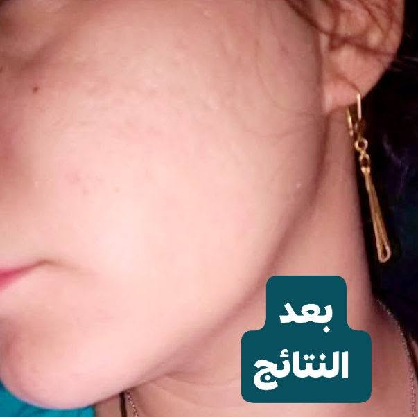 وارررررررررررجع واكسرررررر الدنيه بتجاربنا 
طبعا هل زبونه تعاني جدا من #مسامات #مفتوحه وجدامكم 
#قبل #وبعد شوفواخليته تستخدم البكج خاص بالمسامات شوفوا النتائج شلون تجننننننننننن

نتائج ترفع الرررراس وتخلي الزبون يفرح هواي


**إذا كنت صاحب هذا الإعلان وتريد حذفه لأي سبب، رجاءا أرسل رسالة إلى الدعم الفني**