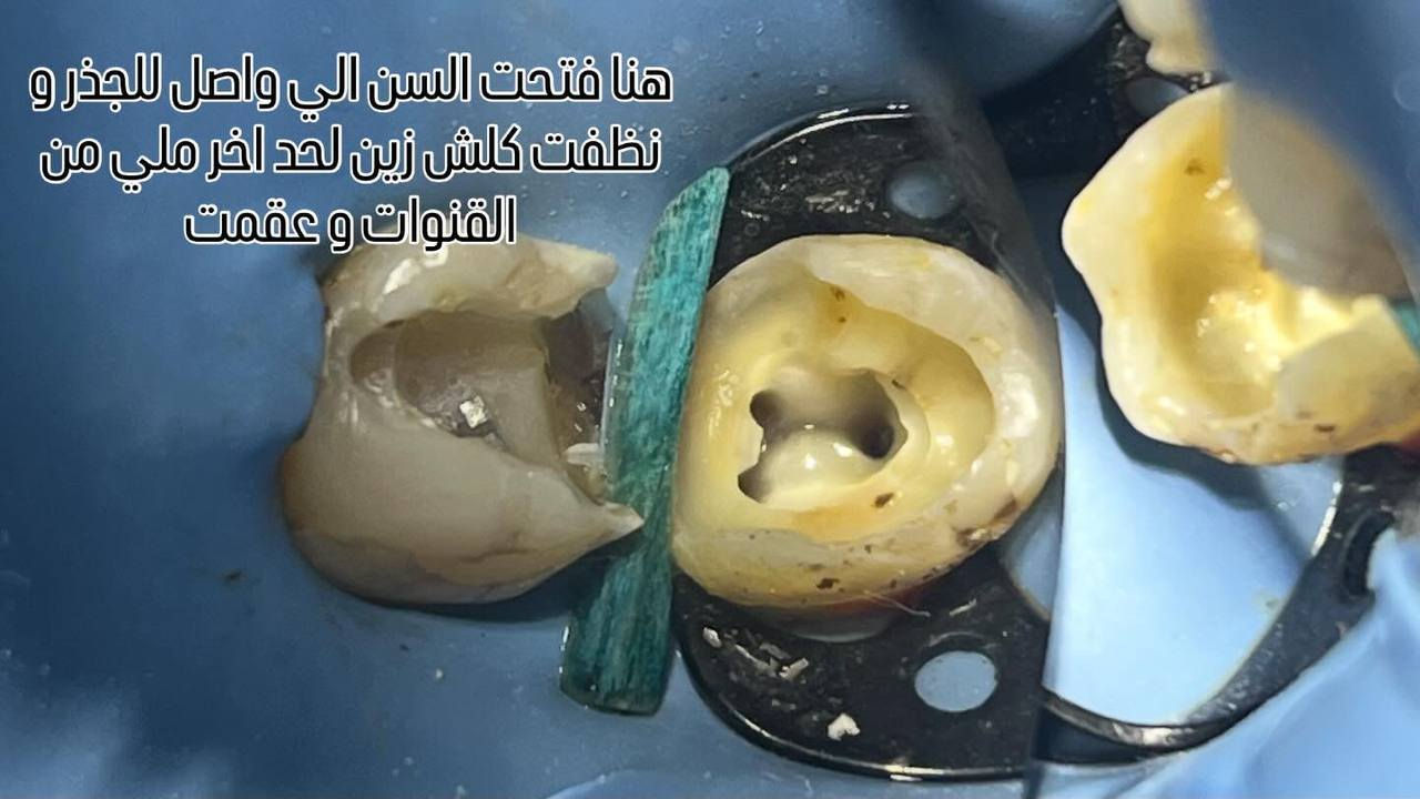 خطوات حشوت الجذر داخل العيادة  
صحة اسنانك ويا عيادة بيانو غير 🥰
 
المكان/ حي 17 الشارع العام لمكتبة المهندس مجاور لمدرسة المشاعل

 للحجز والاستفسار/ ***********
