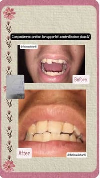 🔴مجاني تماما وتحت إشراف اطباء اختصاص 🔴يتوفر في عيادتنا قلع الأسنان الم...