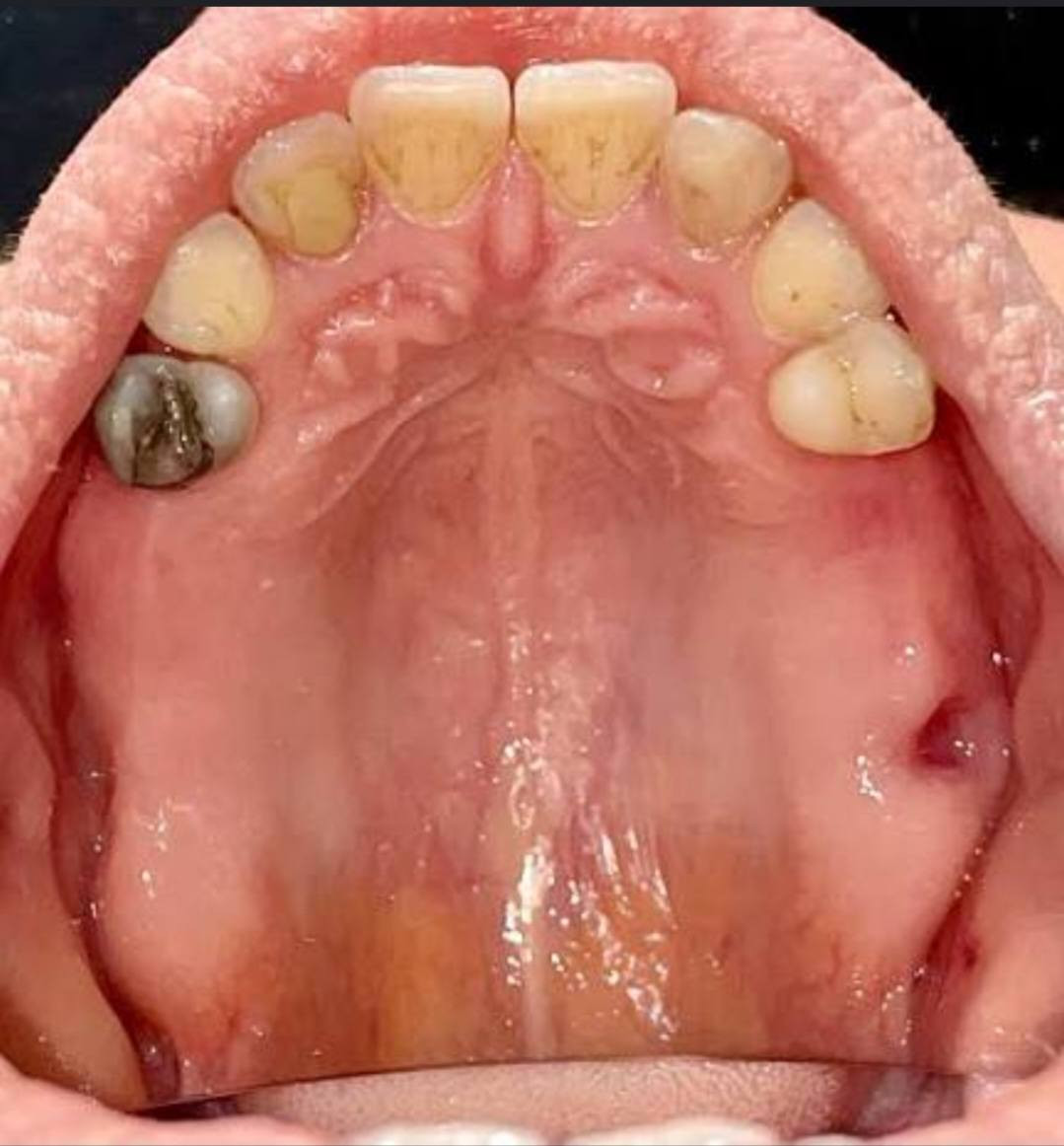 سلام عليكم
طالبة طب أسنان مرحله رابعه
اللي عنده هيك حاله او احد من اقربائه ويريد يسويله تعويض يراسلني واتس ***********
