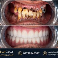 😔 تعاني من تكسّر أو فقدان الأسنان؟  رجّع ابتسامتك وثقتك بنفسك مع زراعة...