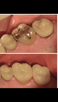 ✨ عيادة سوانا لطب وتجميل الأسنان ✨
كل خدمات الأسنان والتجميل بمكان واحد 🦷🤍
🔹 زراعة الأسنان
🔹 تركيب وتقويم
🔹 حشوات تجميلية وعلاجية
🔹 قلع أسنان للكبار والصغار
🔹 تركيبات زاركون & إيماكس
🔹 فلر – بوتوكس – ميزوثيرابي
📍 العنوان:
الحريّة الأولى – شارع العيادة الشعبية
مجاور الكوخ، يم كباب أبو علي
فوق صيدلية شهد
📞 رقم الهاتف:
( ***********)
📩 احجز موعدك الآن… ابتسامتك علينا ✨
@الجميع
